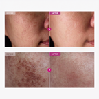 Helm Corrector Cream